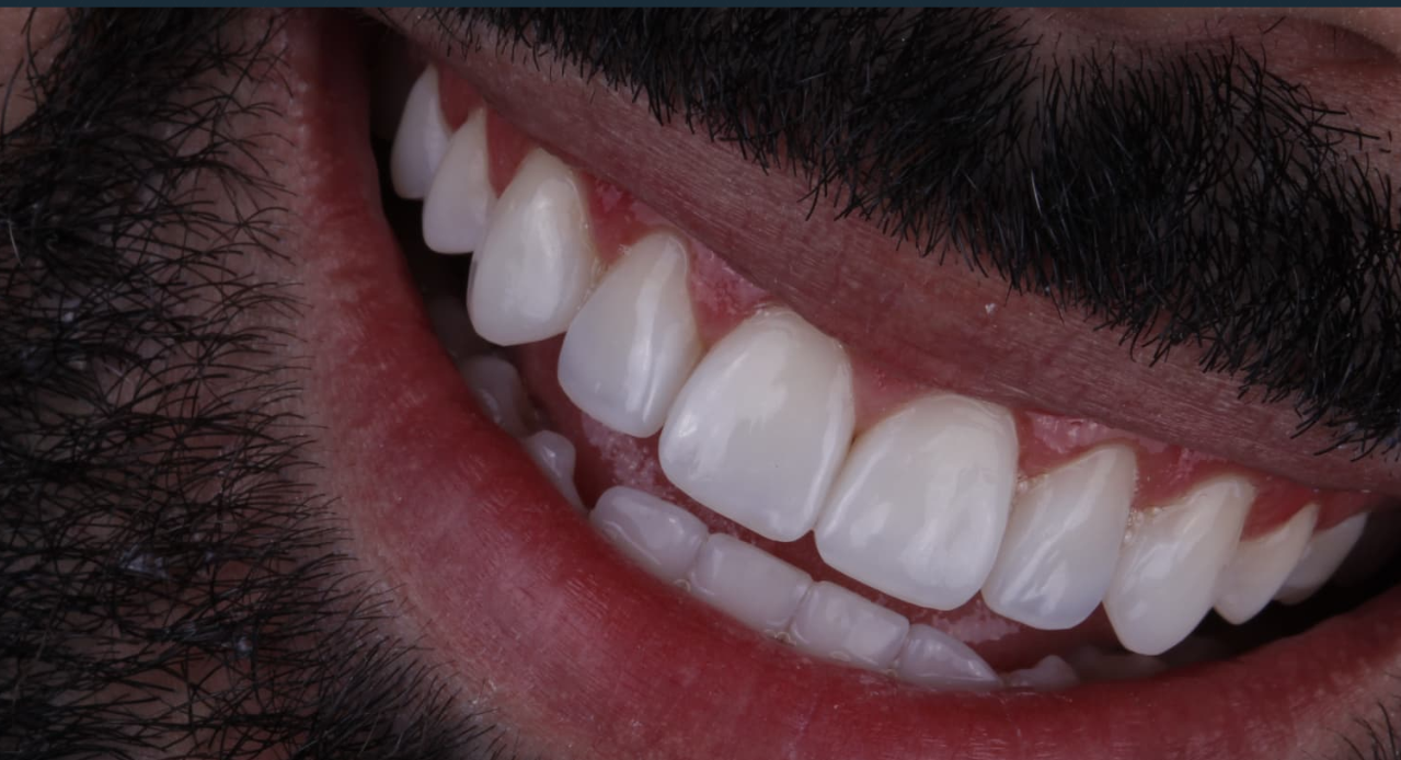 Caso finalizado de reabilitação estética anterior