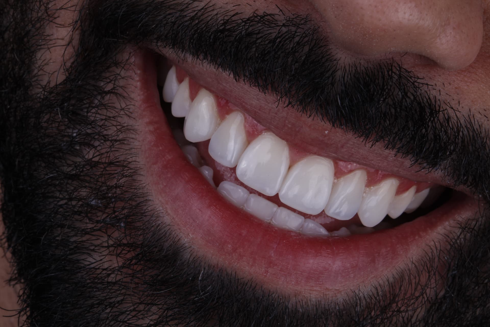 Sorriso finalizado após reabilitação estética